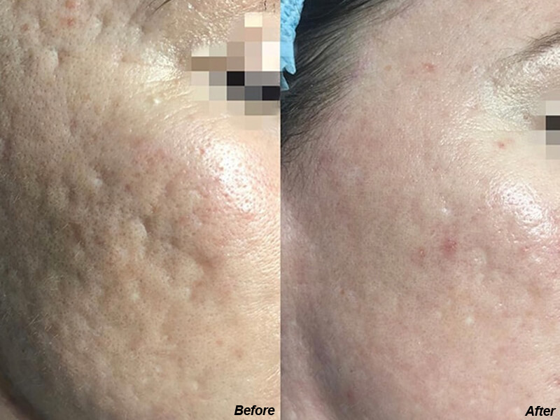 erbium laser treatment