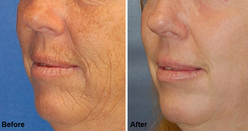 erbium laser treatment