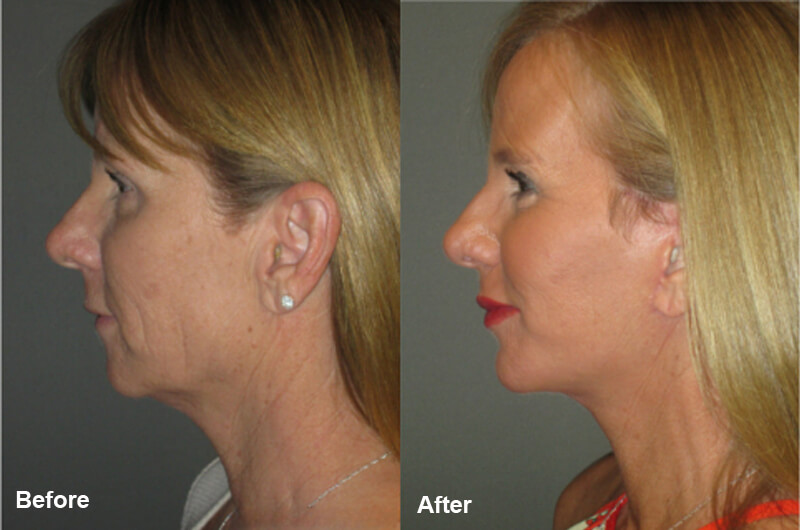 picosecond laser treatment