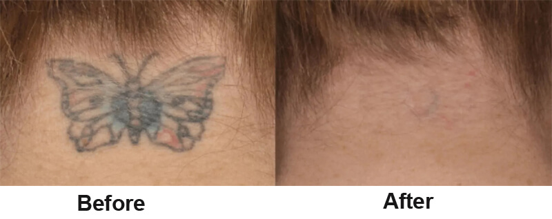 picosecond laser treatment