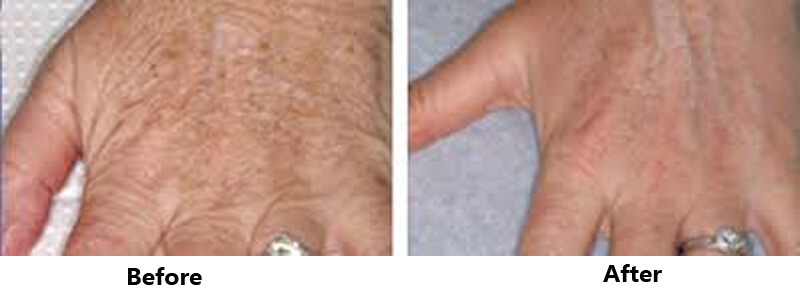 thulium laser treatment
