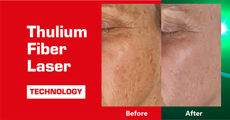 thulium laser machine