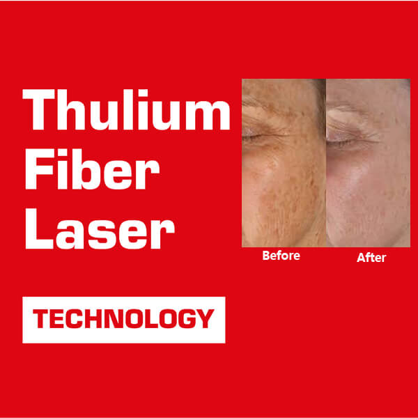 thulium fiber laser