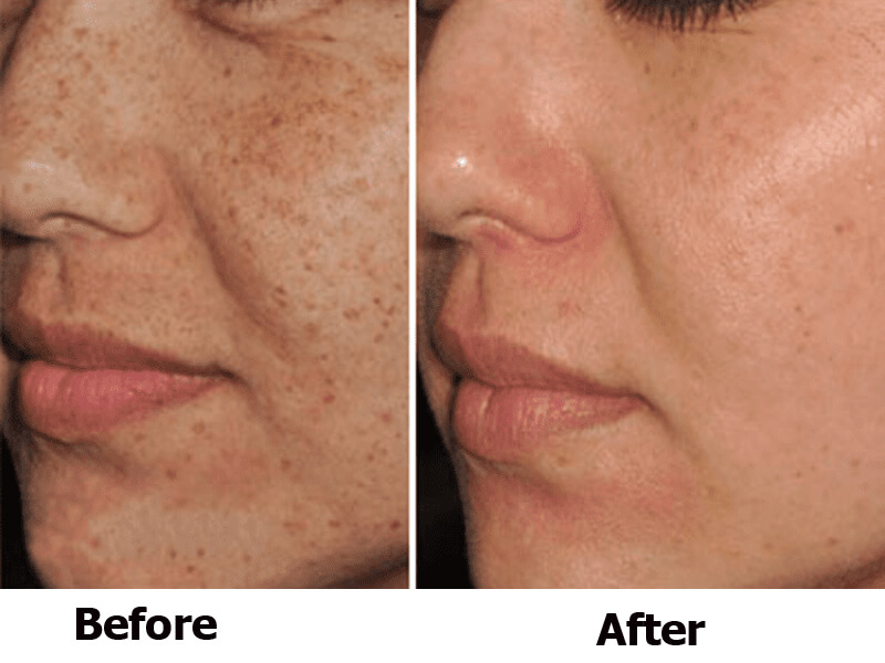 ipl skin rejuvenation treatment