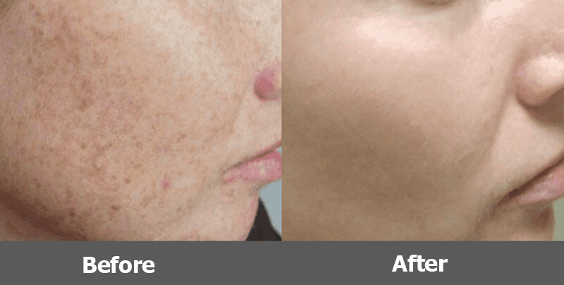 ipl photo facial rejuvenation