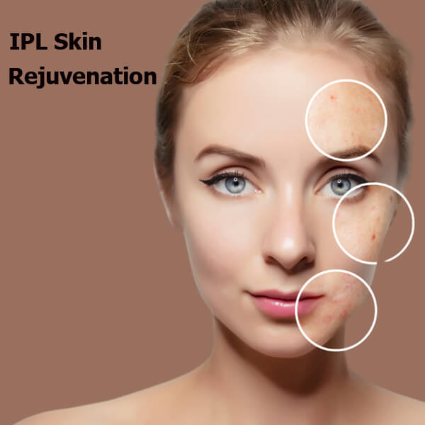 ipl photofacial machine