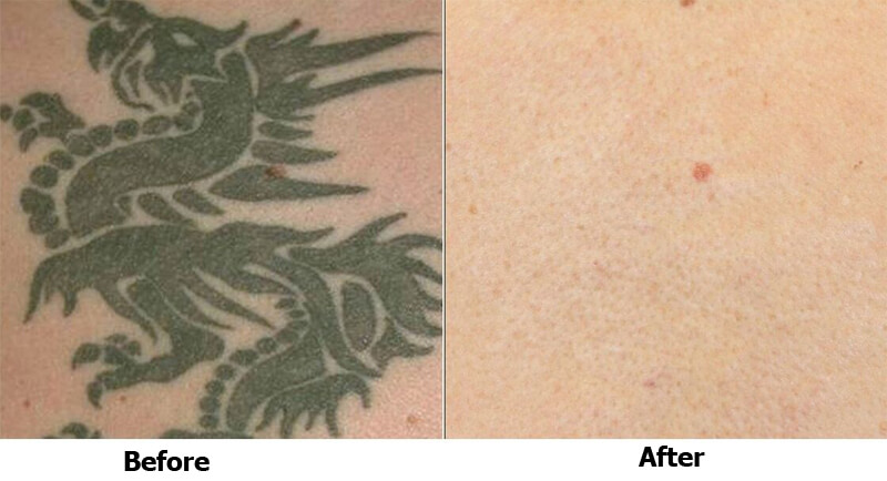 picosecond laser treatment