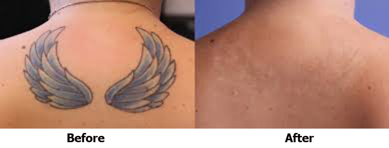 picosecond laser treatment before and after