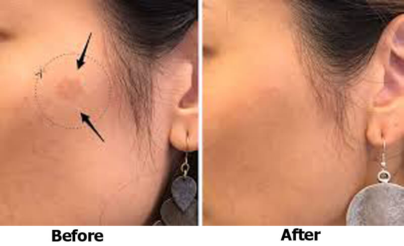 picosecond laser treatment