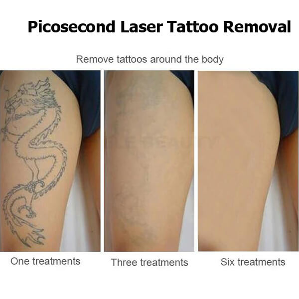 picosecond laser treatment