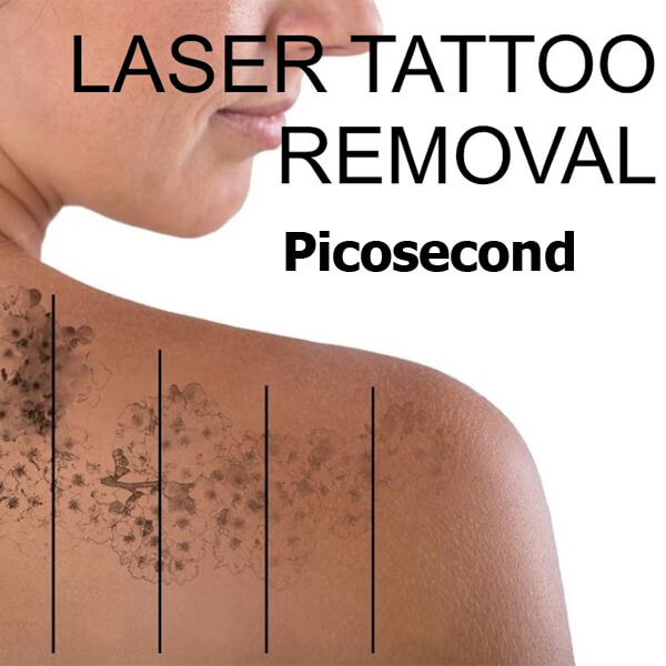 picosecond laser tattoo removal machine