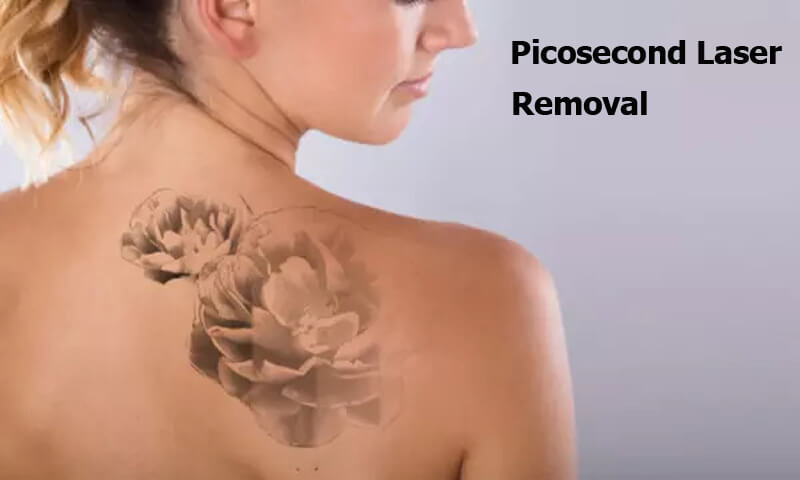 picosecond laser tattoo removal machine
